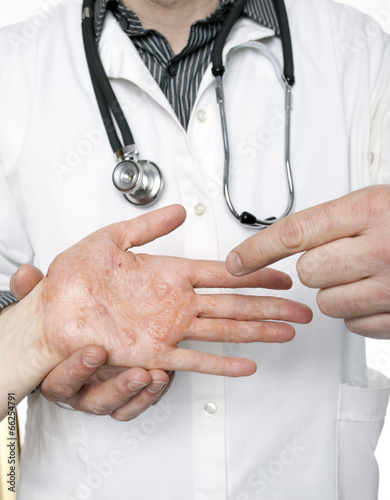 Dermatologist examining hand with severe eczema