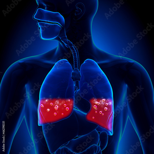 Tableau sur toile Pulmonary Edema - Blood in Lungs