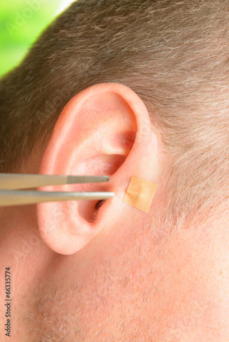 Auriculotherapy