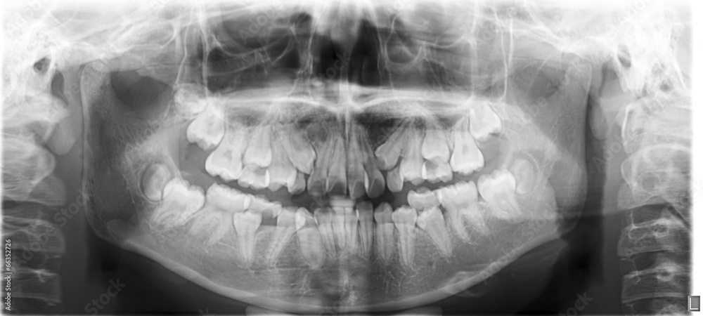 panoramic x-ray of mixed dentition Stock Photo | Adobe Stock