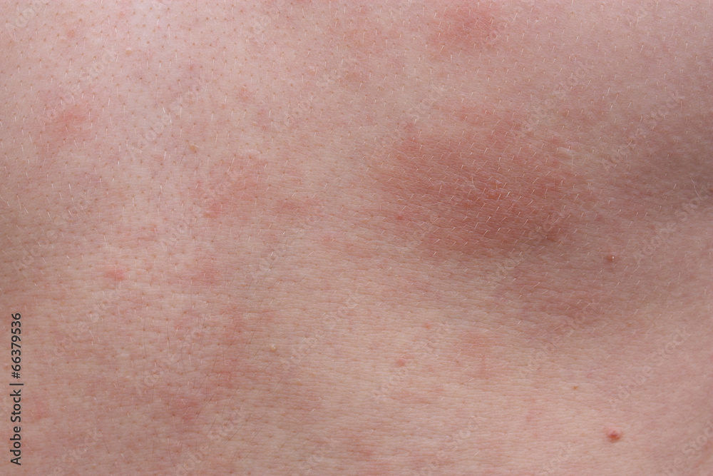 Example dermatological skin allergy