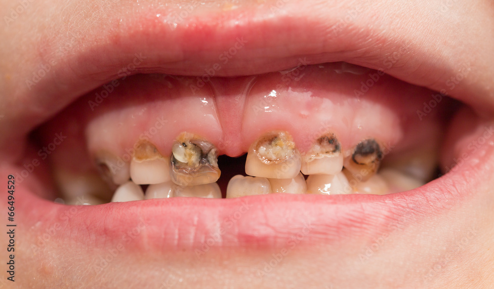 Obraz premium rotten teeth. macro