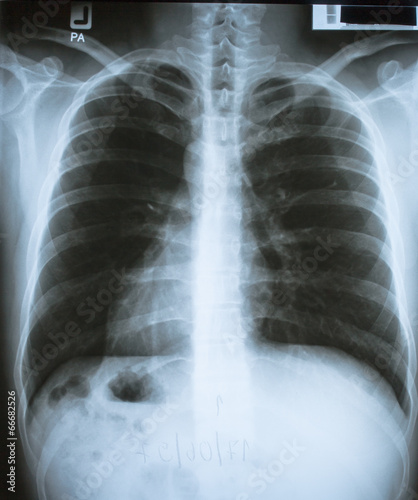 X ray Photograph