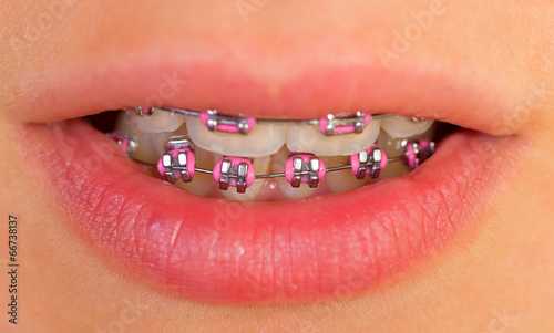 Pink braces