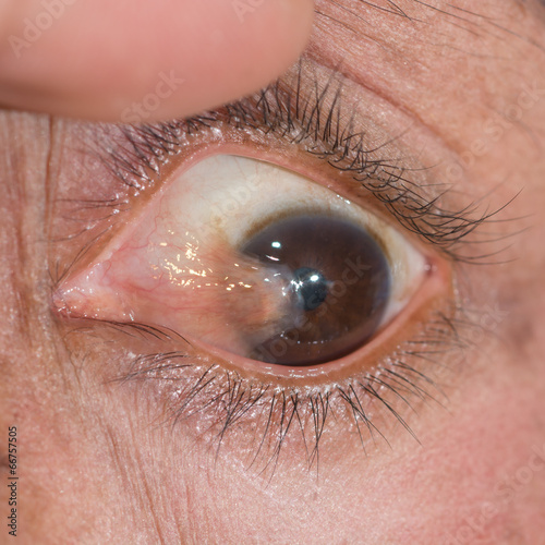 Eye exam