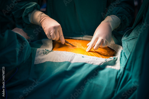 median sternotomy incision photo