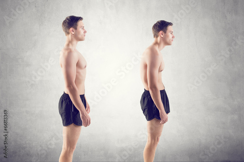 Man with impaired posture position defect scoliosis and ideal