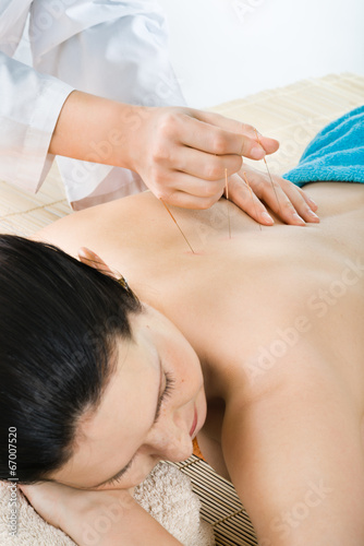 acupuncture photo