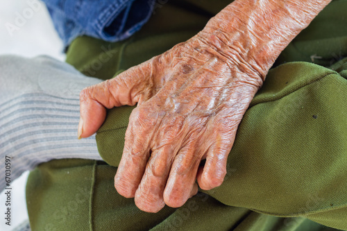 left hand of a leprosy