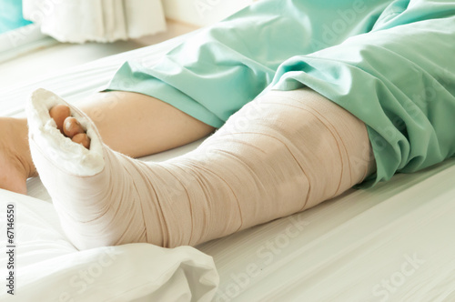 Broken Leg