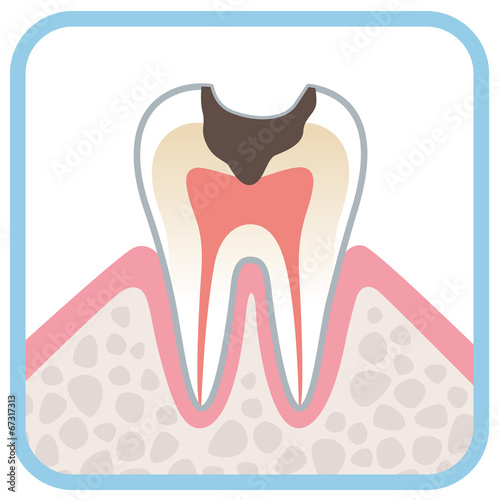 歯の断面図　虫歯 #67317313