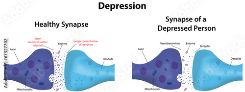 Depression Labeled Diagram