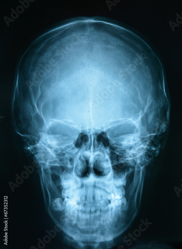 X-ray picture of the skull 
