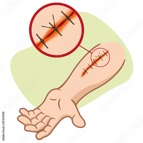 First Aid suture injury
