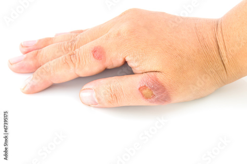 Hand a teenager with blisters due to burns