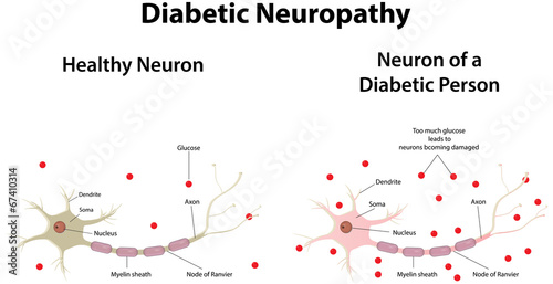 Diabetic Neuropathy