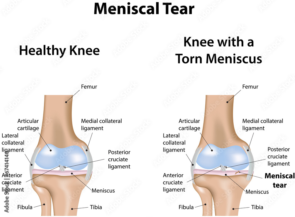 Fotografija Meniscal Tear