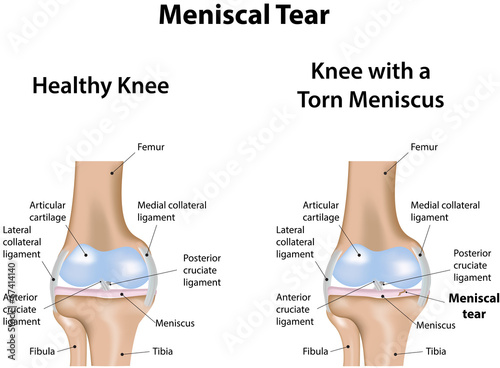 Meniscal Tear photo