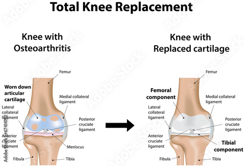 Total Knee Replacement
