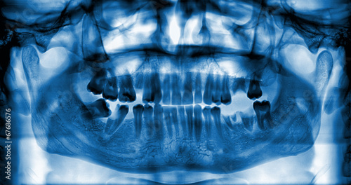 Photos Panoramic dental x-ray image of teeth.
