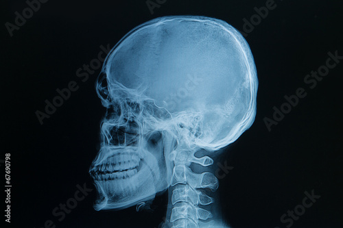 skull x-rays image photo