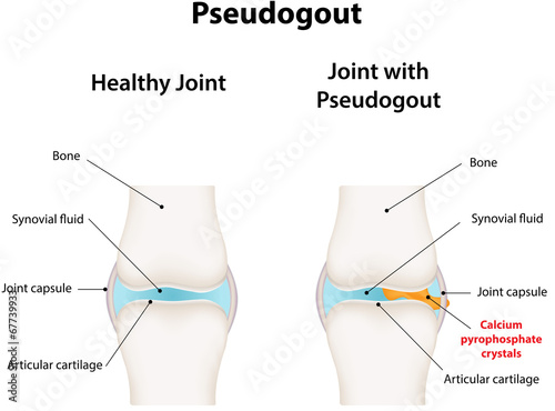 Pseudogout photo