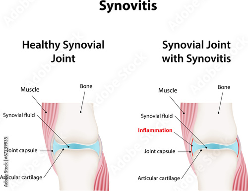 Synovitis photo