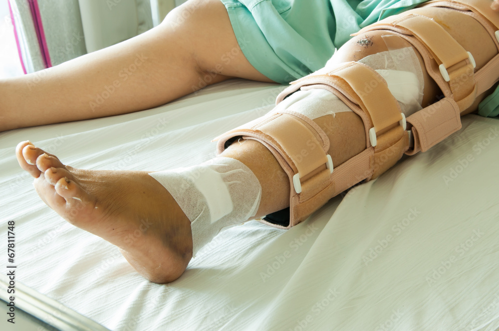 woman wearing a leg brace, Broken leg Stock Photo