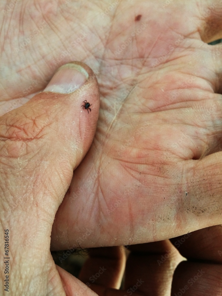 Tick-borne encephalitis sit on the arm Tick-borne encephalitis sit on the arm
