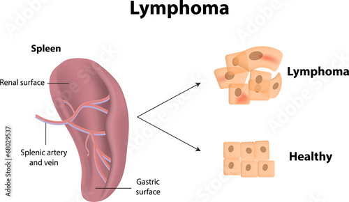 Lymphoma