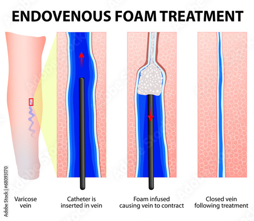Foam Sclerotherapy. Sclerofoam
