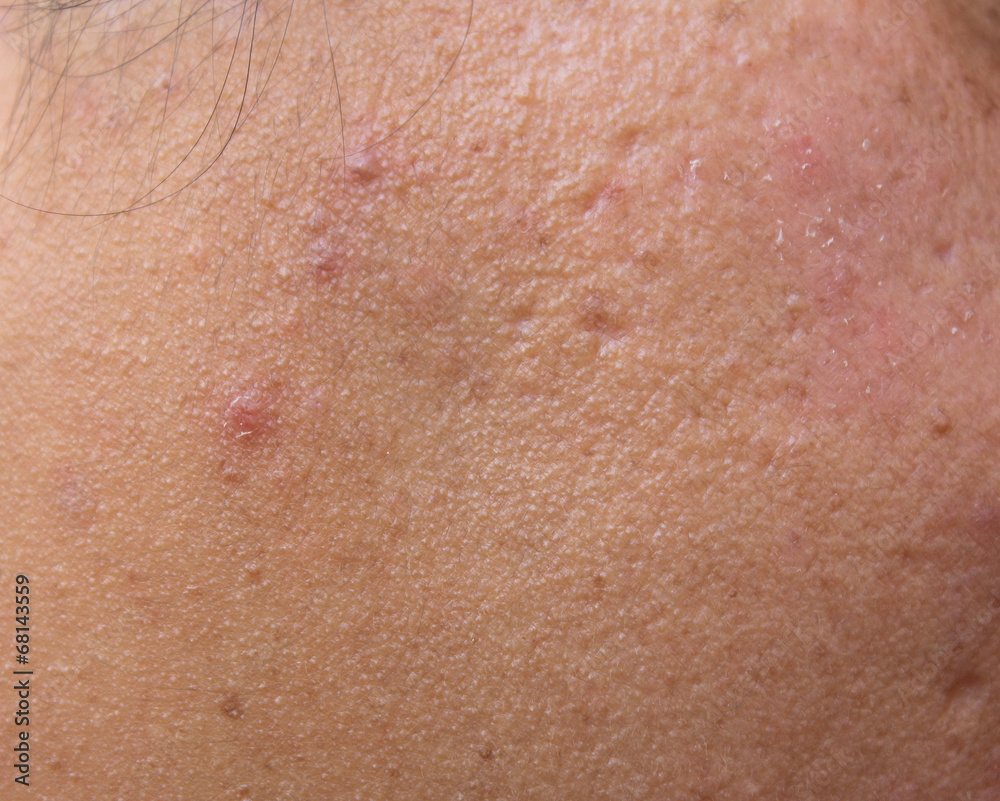 Woman with oily skin and acne scars