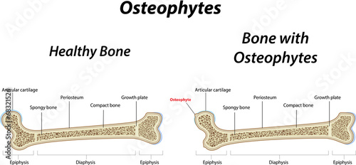 Osteophytes photo