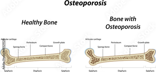 Osteoporosis