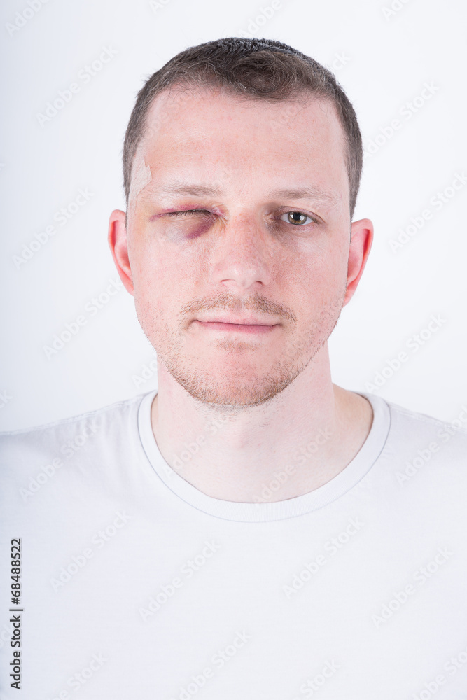 Obraz premium Mann mit blauem Auge
