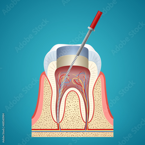 Dental injection in cutaway