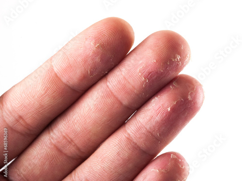 Closeup of Eczema Dermatitis on Back of Fingers