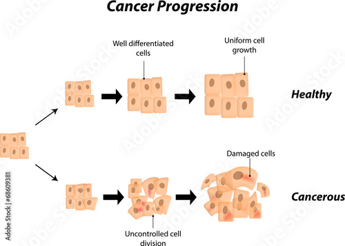 Cancer Progression