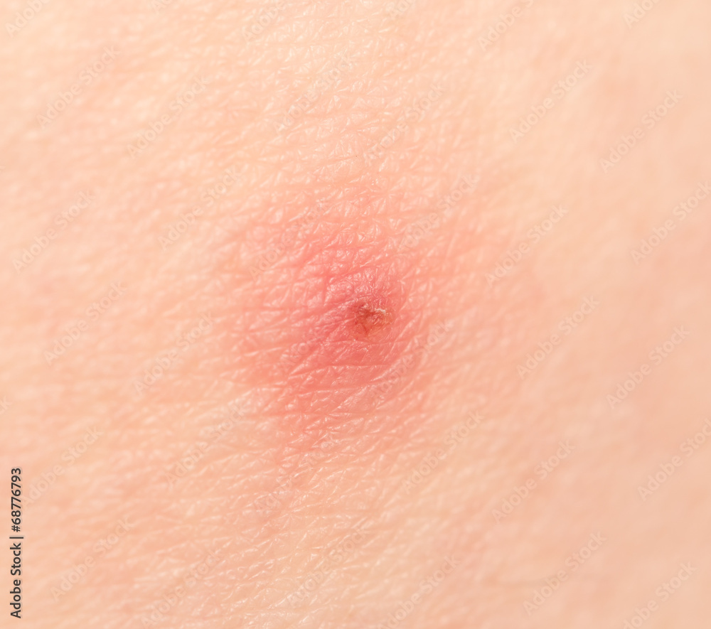 Fototapeta premium bee sting on the skin. macro