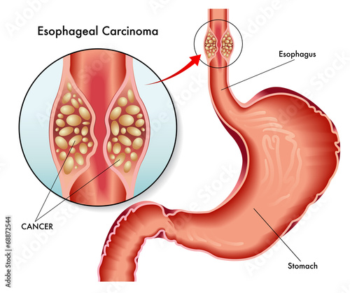 carcinoma esofageo photo