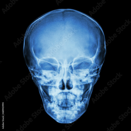 normal thai child's skull