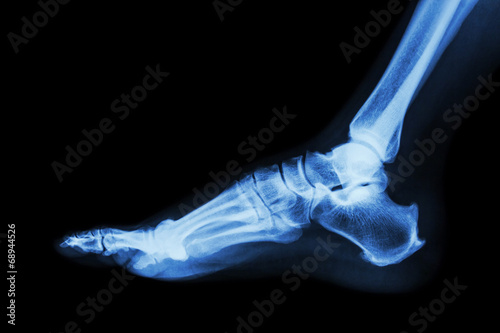 X-ray normal foot lateral © stockdevil