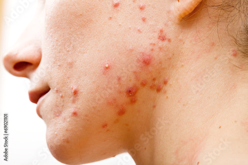 Acne skin photo