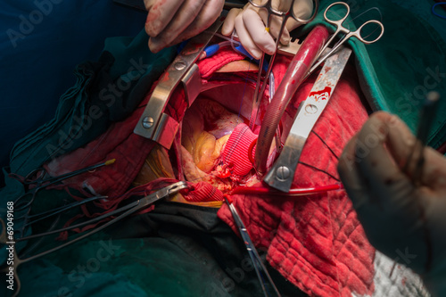 bentall's operation in ascending aortic aneurysm