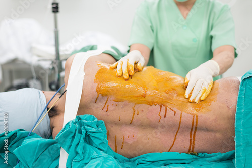 scrub nurse scrub patient prepare for chest operation photo