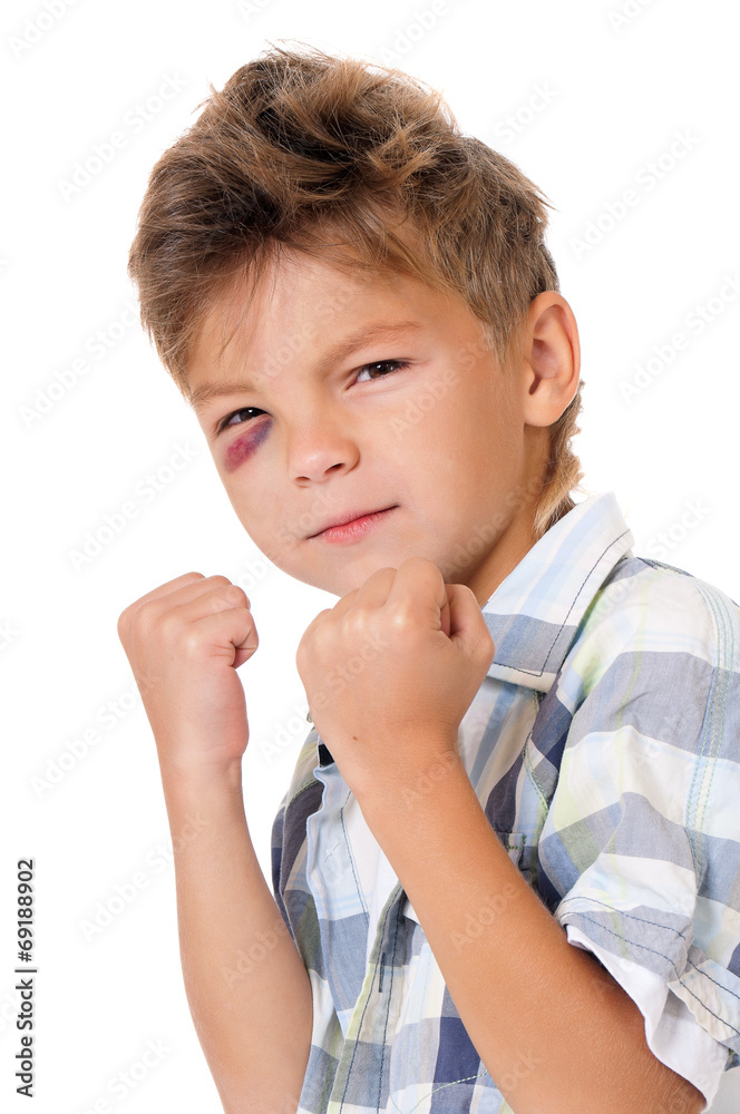 Boy with bruise