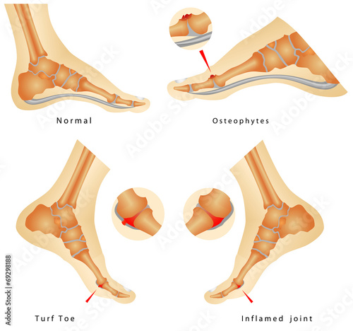 Turf Toe Injuries