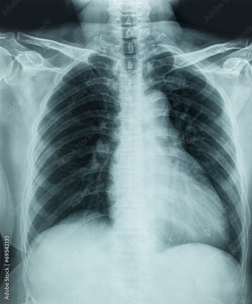 X-Ray X-Ray