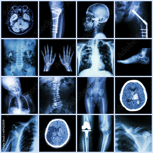 Set of X-ray multiple part of human,Multiple disease