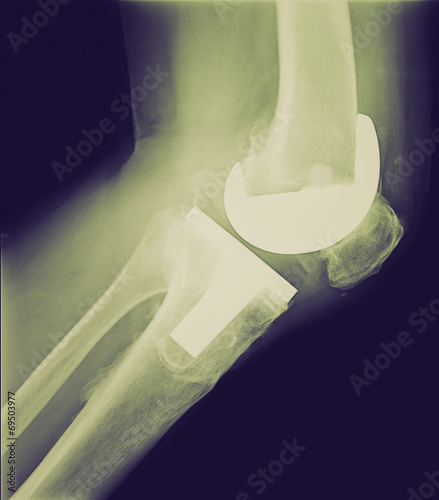 Retro look Bicompartmental knee prosthesis xray